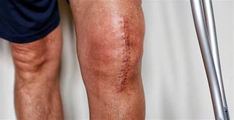 knee injury dardenne prairie mo|Total Knee Replacement Physical Therapy in Dardenne Prairie, .